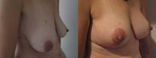 Levantamiento Mamario 15 días postoperatorio (Retiro de piel excedente, reposicion del pezón , sin retiro de tejido mamario)